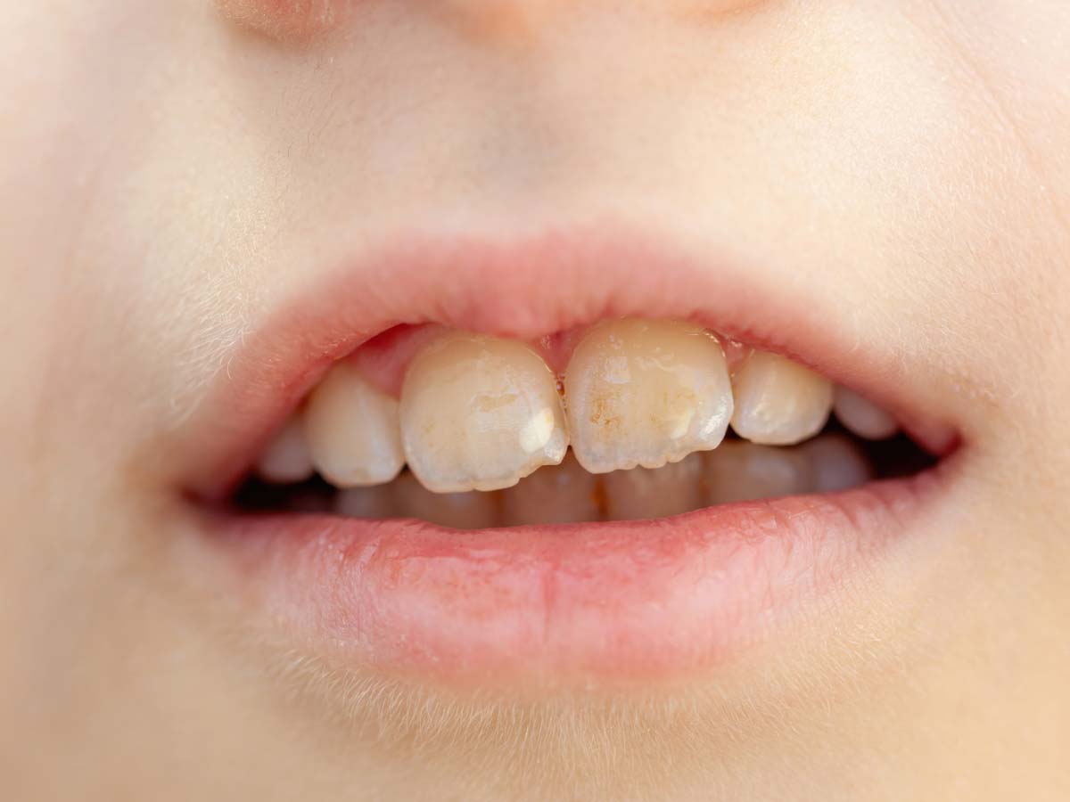 dentistsatmetrotown blog Dental Acid Erosion