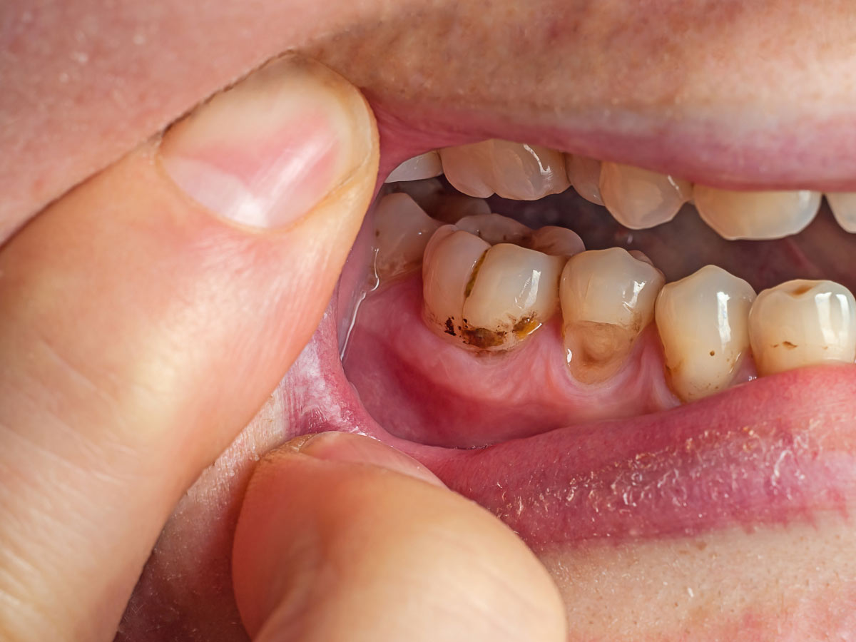Dentist explaining how smoking affects dental implants to a patient