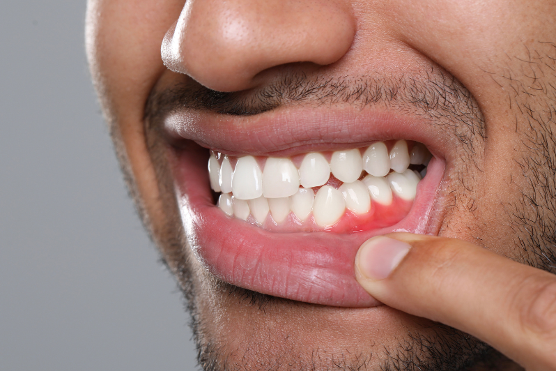 Healthy vs Unhealthy Gums uai