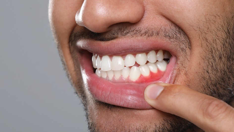 Healthy vs Unhealthy Gums