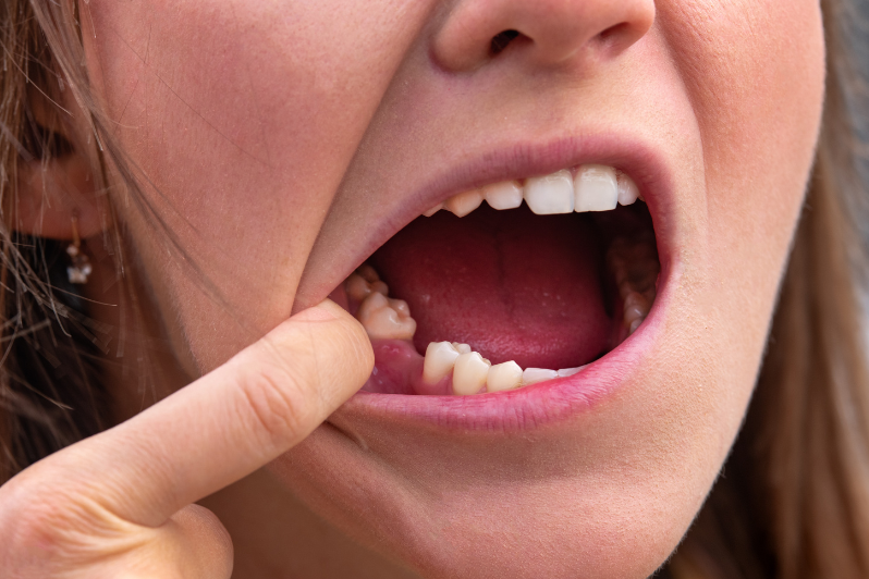 Missing teeth treatment options explained by a dentist at Metrotown