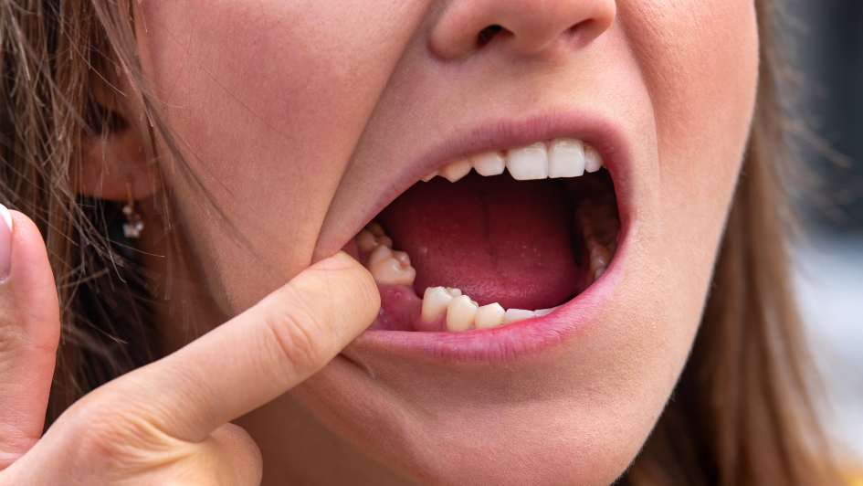 Missing teeth treatment options explained by a dentist at Metrotown