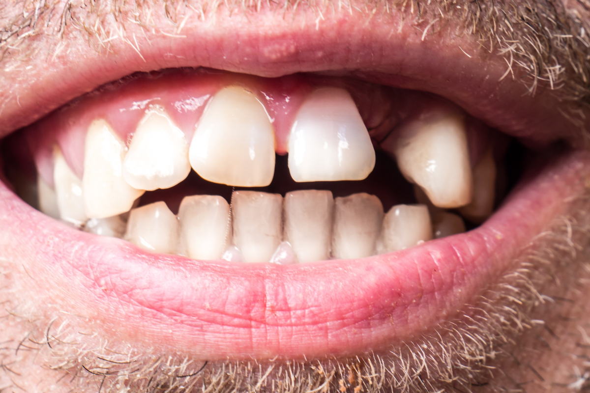 Invisalign for gaps in teeth before and after treatment results