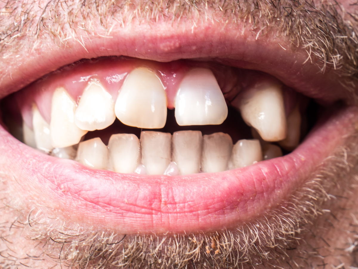 Invisalign for gaps in teeth before and after treatment results